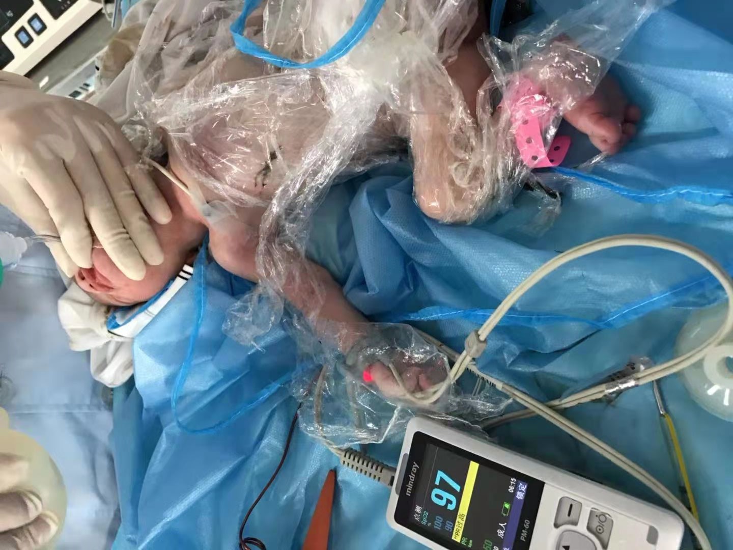 生死时速抢救重度缺氧新生儿创造生命奇迹